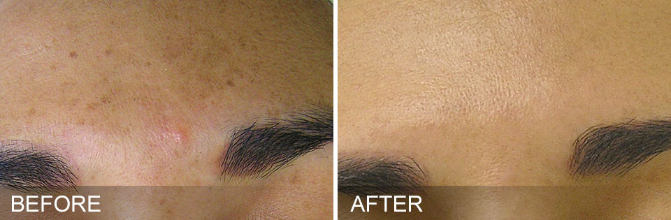 brown spot removal skin resurfacing