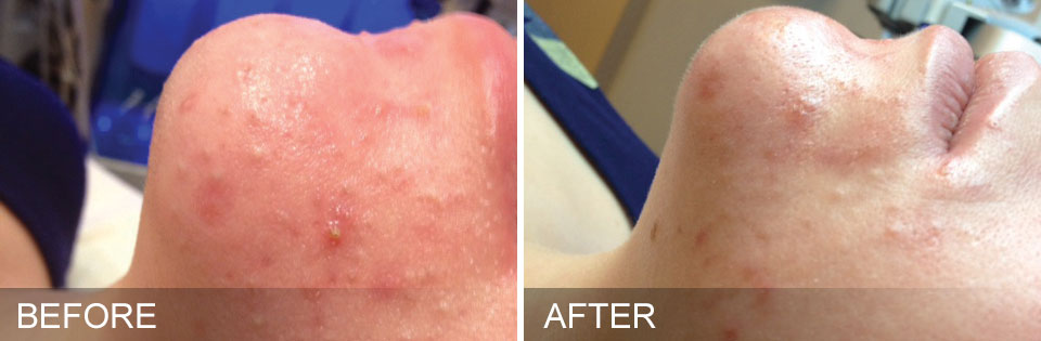 acne treatment before and after photos