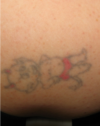 Baby Devil Tattoo before it was removed at Nirvana Medical Spa.