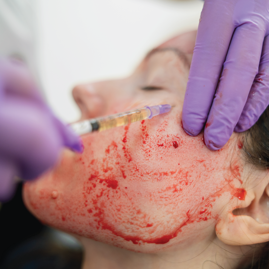 Platelet-Rich Plasma Therapy demonstrated using your own plasma cells to rejuvenate your skin.