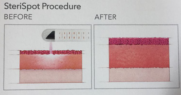 Before and After of the Juliet Laser procedure