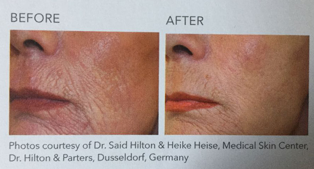 Fine lines and wrinkles almost disappear with the Juliet Laser