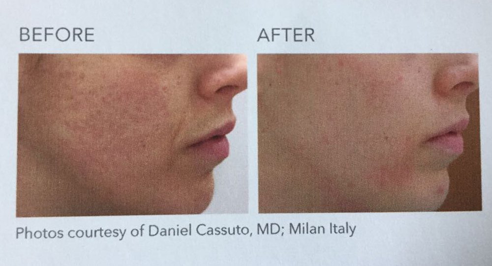 Before and After the Juliet Laser Procedure at Nirvana Medical Spa
