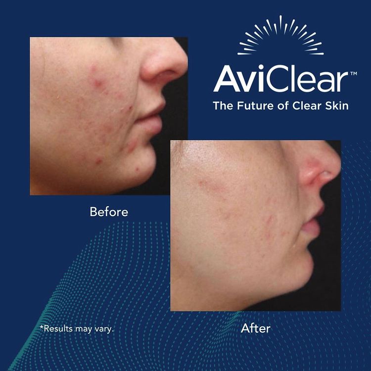 Aviclear before and afer