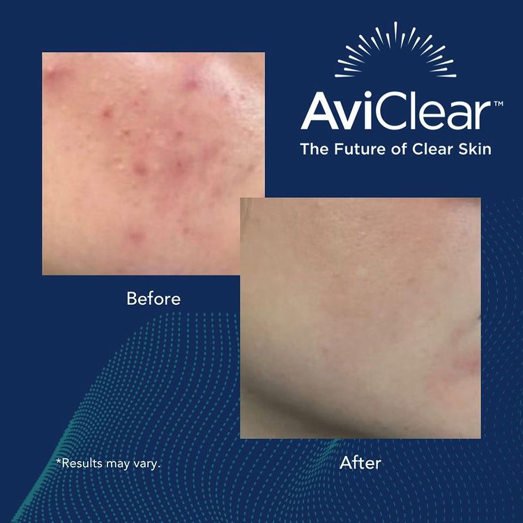 Aviclear before and after 2