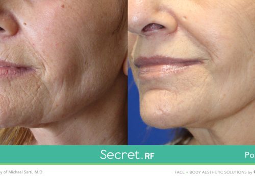 Secret-RF-13-1500x841