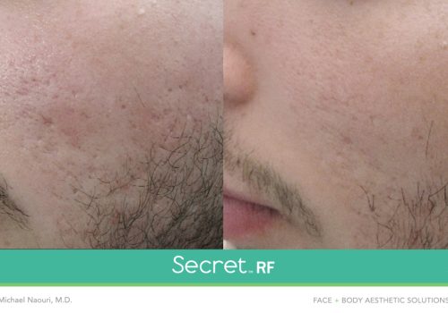 Secret-RF-3-1500x780